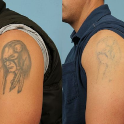 tattoo removal before and after